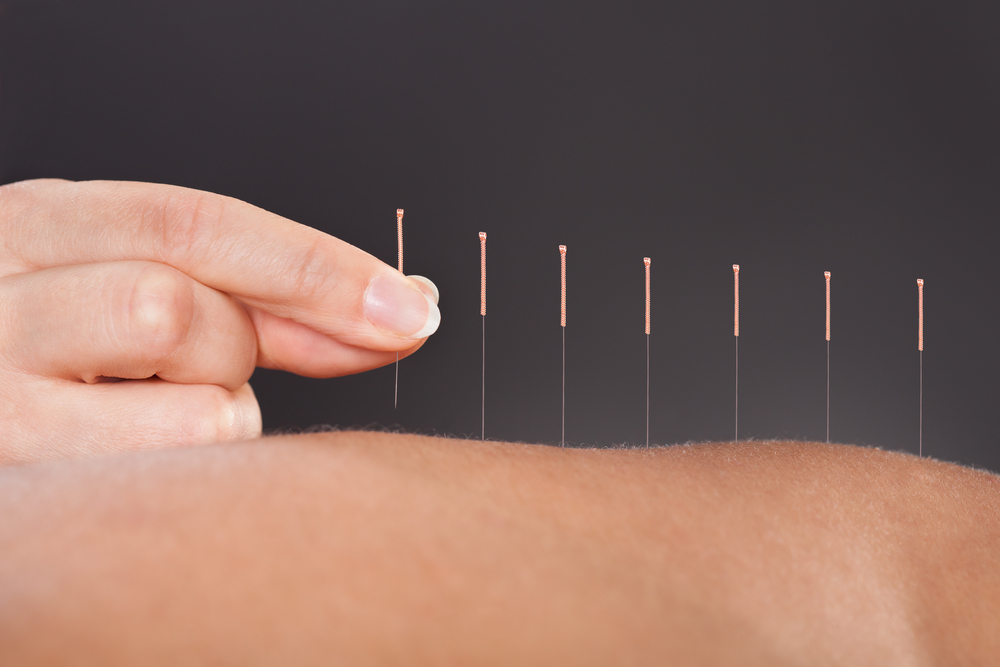 Medical Acupuncture Treatment